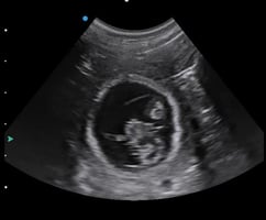 Pregnancy diagnosis using ultrasound
